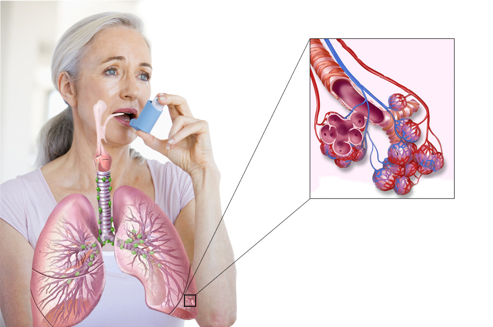 Bronchial asthma. Бронхиальная астма. Инфекционно-аллергическая бронхиальная астма это. Заболевания дыхательной системы бронхиальная астма. Бронхит астма касаллиги.