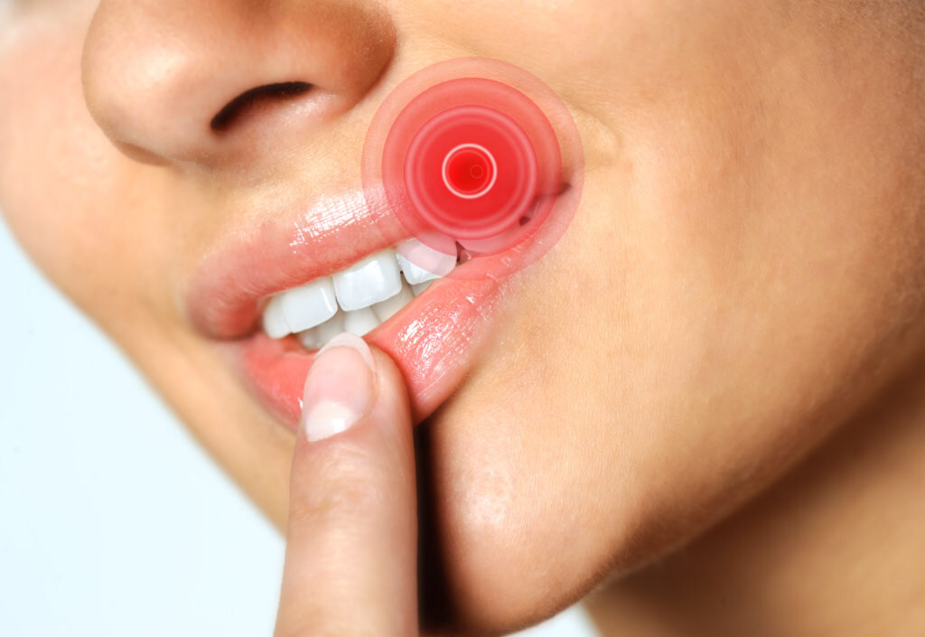 Губы поражённые герпесом