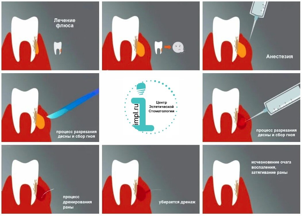 Флюс зуба: что это и как лечить | ГК «ЦСИ» | Дзен