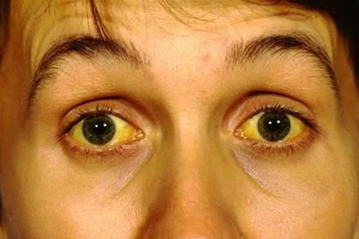 Почему глаза желтые и кожа желтая. Иктеричность склер билирубина. Симптомокомплекс желтуха. Паренхиматозная желтуха иктеричность склер.