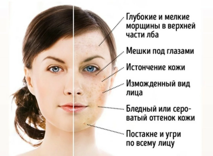 Вред слишком большого количества сахара для кожи лица