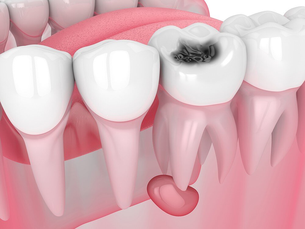 Памятка для пациентов после лечения кариеса и пломбирования зубов - Smile-at-Once