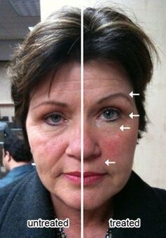 Три месяца делали процедуры на одной половине лица 