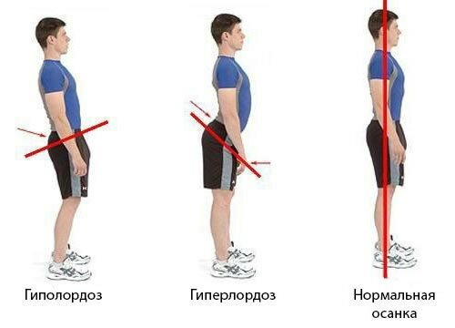 Нарушение осанки: симптомы, причины, диагностика, лечение