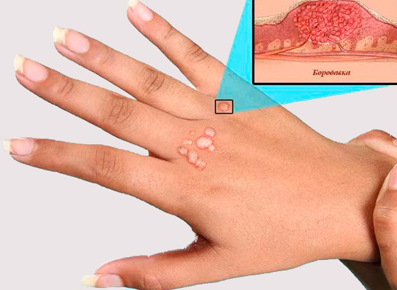 Обычная бородавка