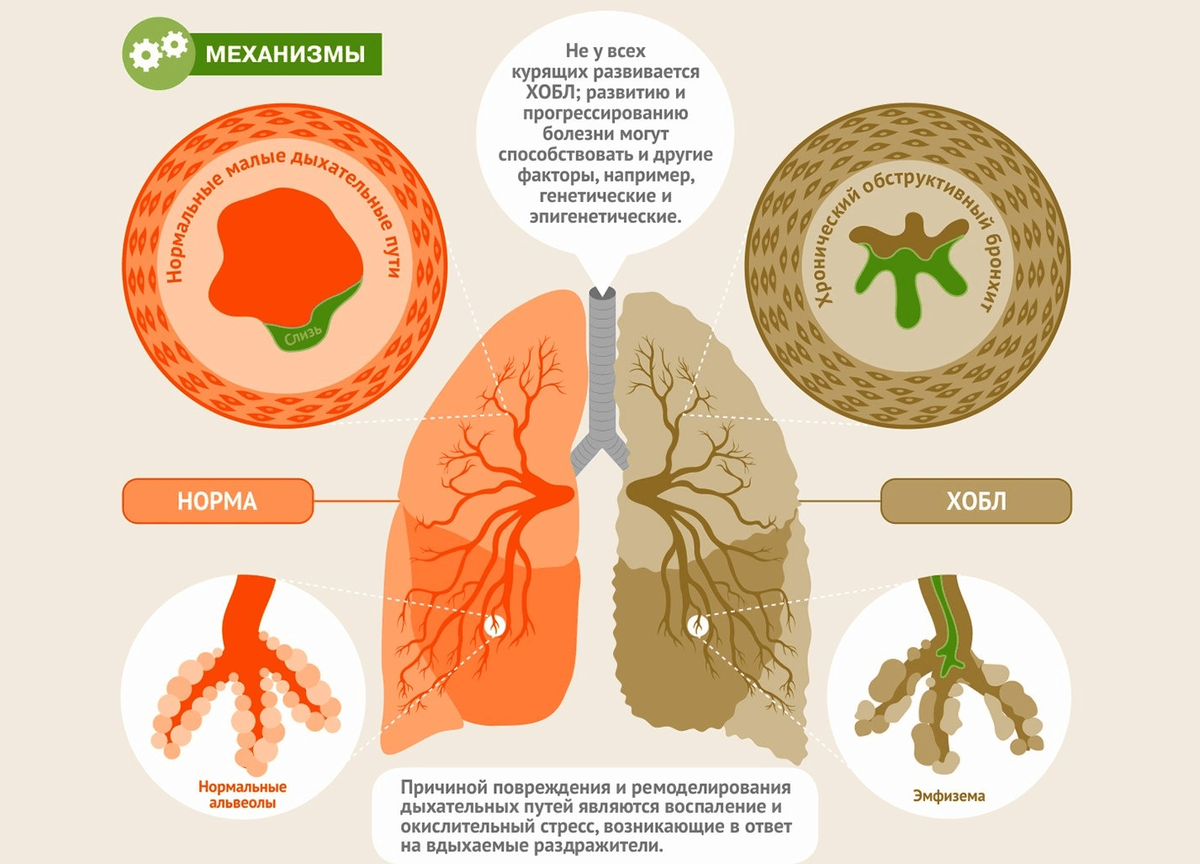 новообразование в легких. ацинарный пневмофиброз. почему заболело легкое. пневмококковая пневмония. боль в грудной клетке.