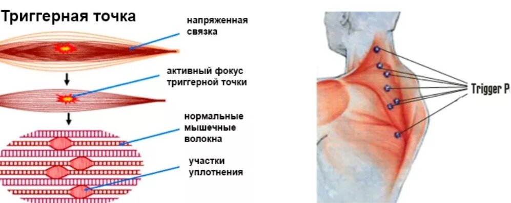 Триггерные точки. Строение триггерной точки. Сателлитные триггерные точки. Триггерная точка в мышцах. Мышечные зажимы триггерные точки