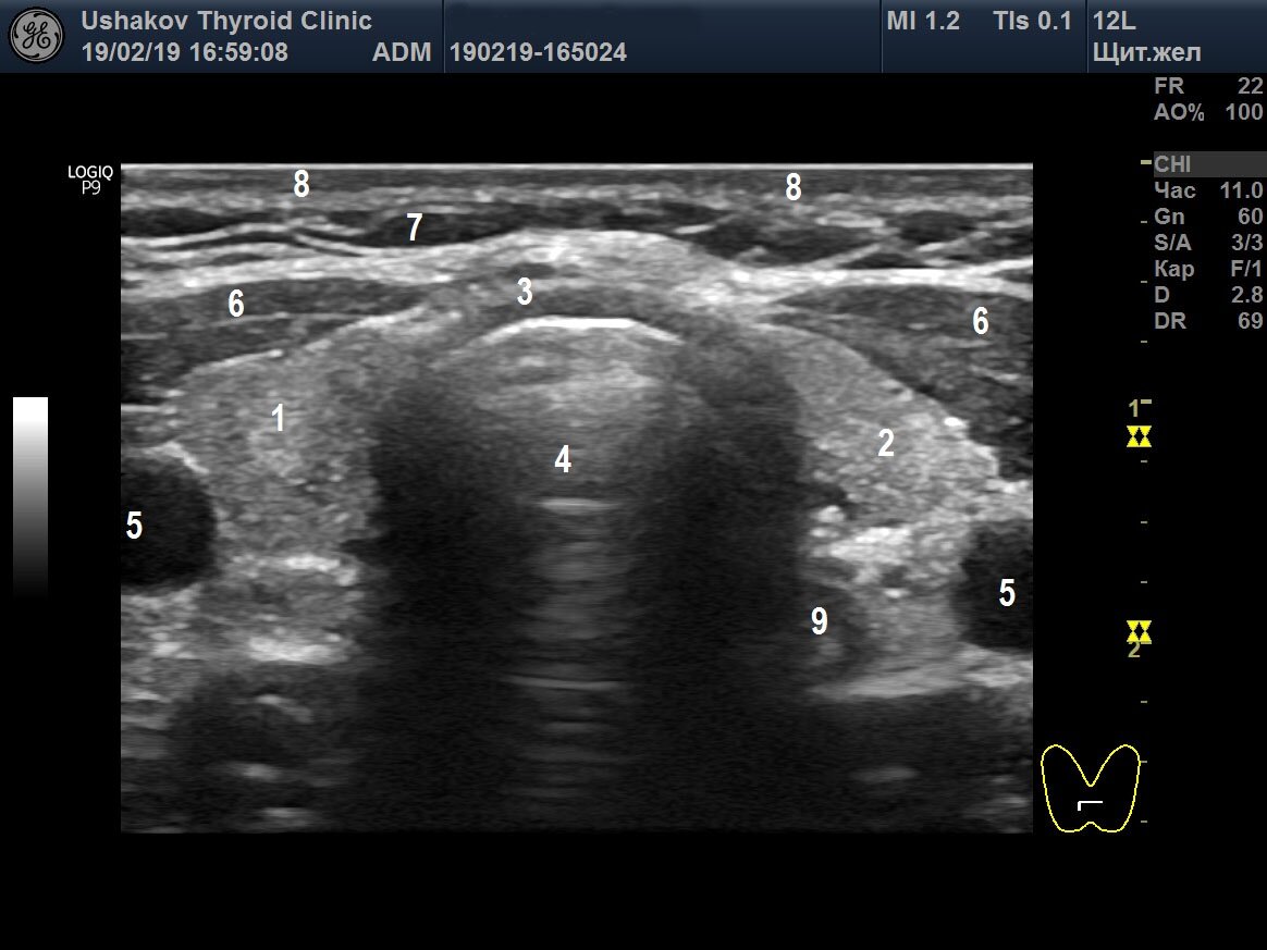 Узи щитовидной железы картинки