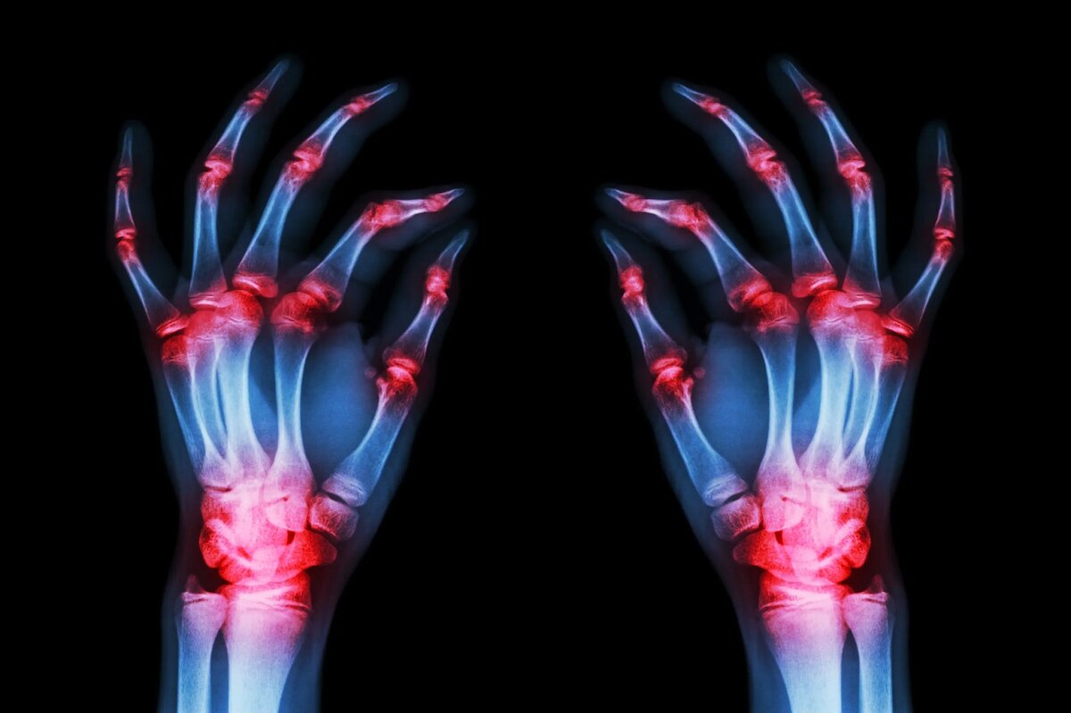     Ученые нашли способ блокировать воспаление, вызываемое ревматоидным артритом: открытие, которое перевернет медицину