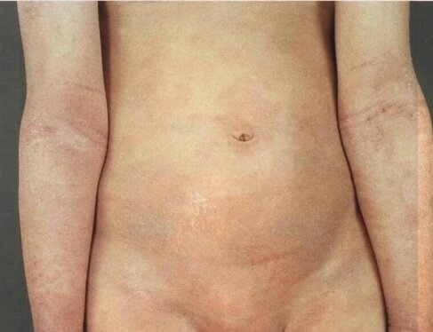 Hyde prurigo nodularis complicated by pyoderma in an adolescent