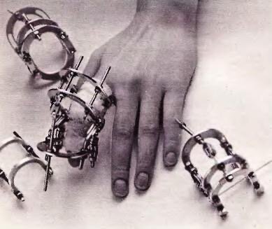 Это и есть аппарат «Илизарова»