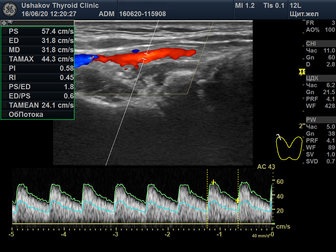 узи допплерометрия. обратный кровоток. проба вальсальвы узи вен. венозный проток допплерометрия. депонирование крови.