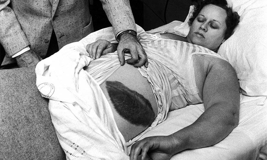 Энн-Ходжес единственный человек, который выжил после прямого попадания метеорита.