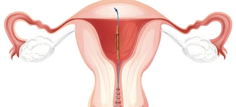 Полип эндометрия (полип матки)