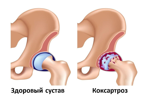 Самый крупный сустав у человека – тазобедренный. Его практически невозможно восстановить, если началось разрушение. Но отсрочить операцию по замене сустава на эндопротез и облегчить боль можно.-2