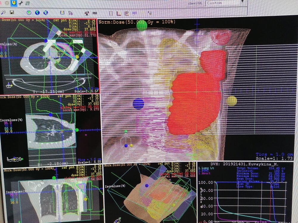 Лучевая терапия при раке молочной. Трехмерная конформная лучевая терапия (3d-CRT). Дистанционная лучевая терапия молочной железы. Оконтуривание в лучевой терапии. Планирование лучевой терапии 3d.
