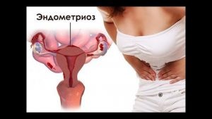 Если причина симптомов гинекологической болезни связана с миомой, то лечение зависит от её размера и локализации. Могут потребоваться препараты, уменьшающие её объем, или хирургическое удаление.