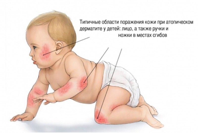 Эксфолиативный дерматит – причины и лечение синдрома ошпаренной кожи