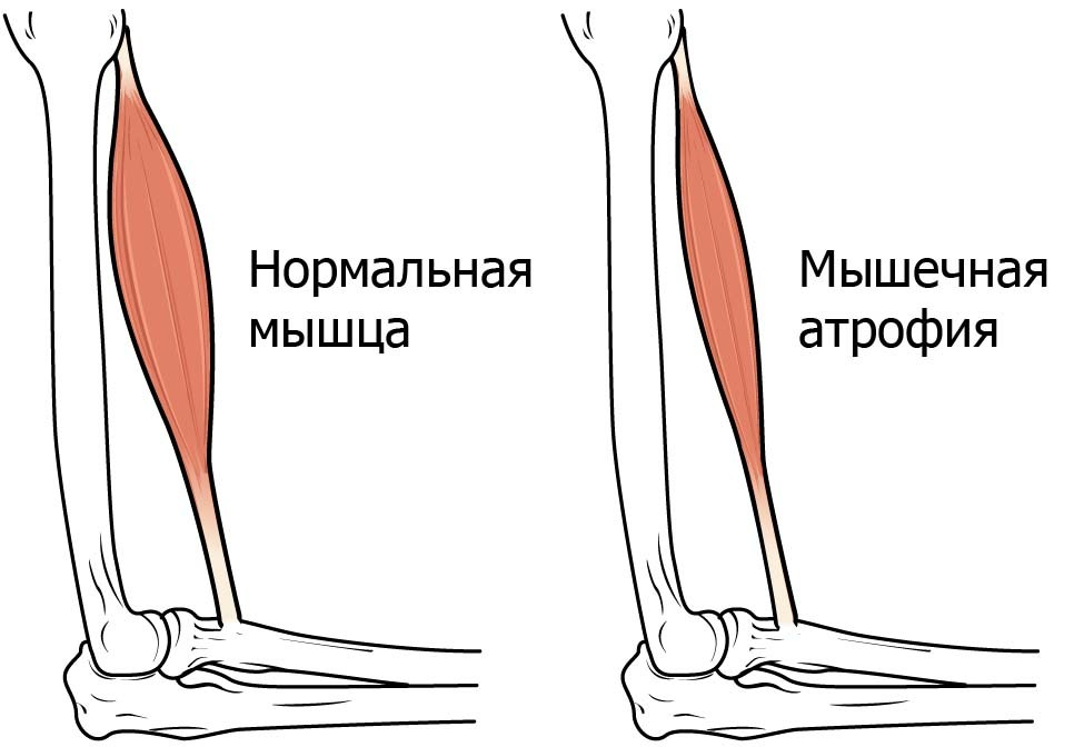 Лечение мышцы голени. Атрофия икроножных мышц. Атрофированные мышцы голени. Гипотрофия мышц голени.