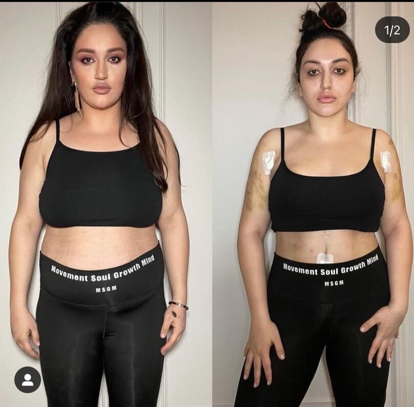 Фотографии до и после липосакции