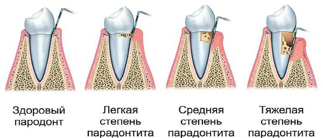 Степени развития пародонтити. Картинка из свободных источников.