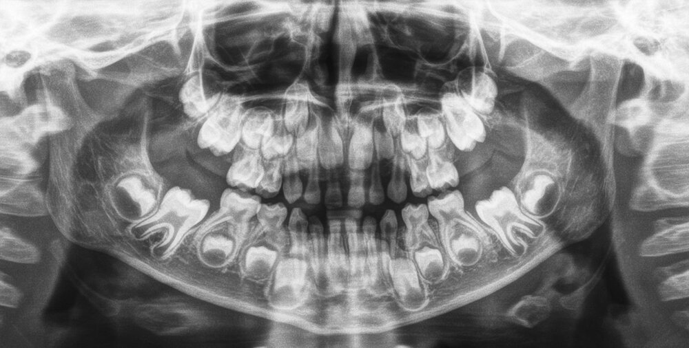 Рентген детских зубов с молочных фото