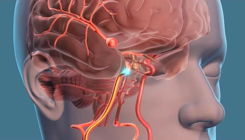 Аневризма головного мозга