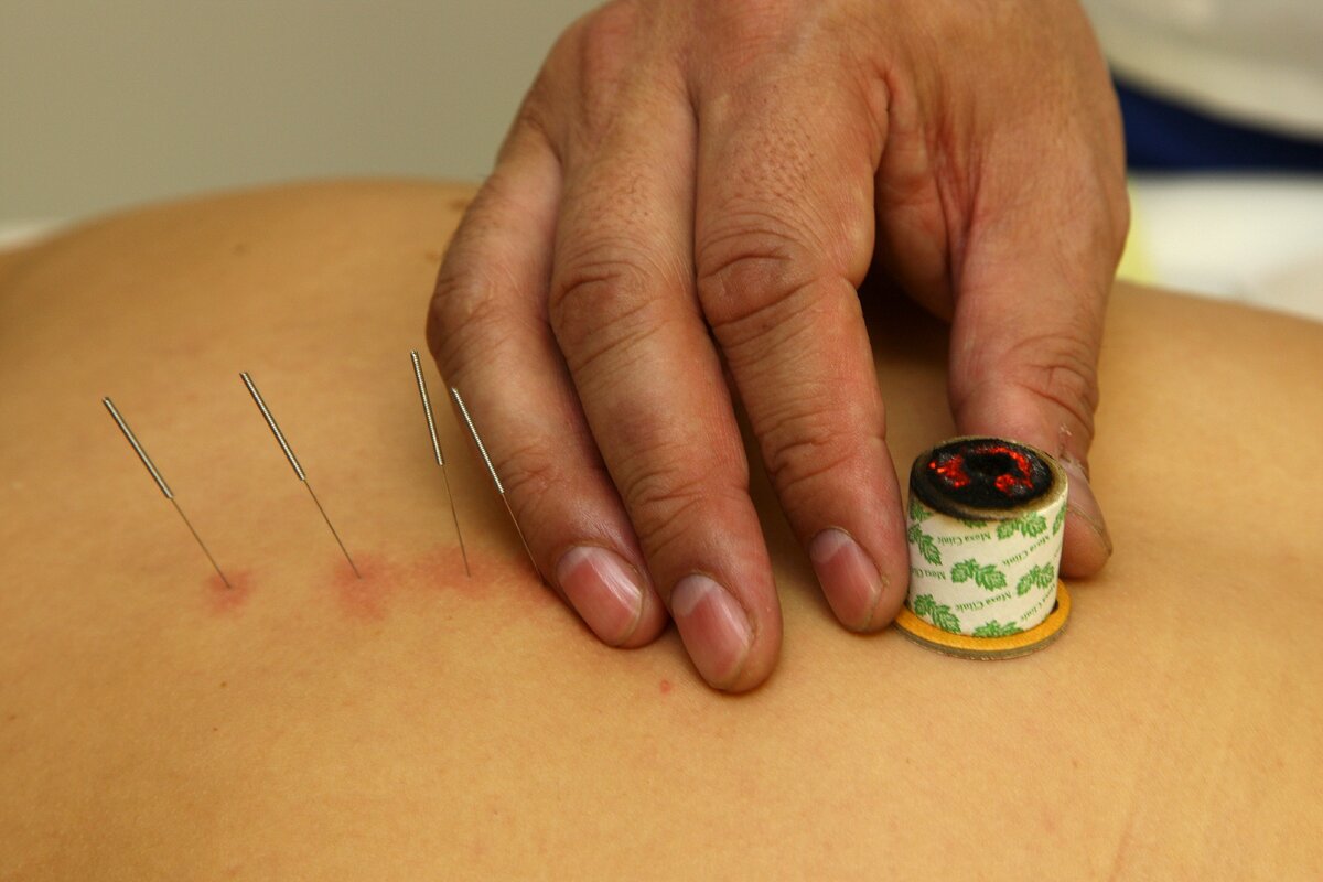 Иглорефлексотерапия, моксотерапия