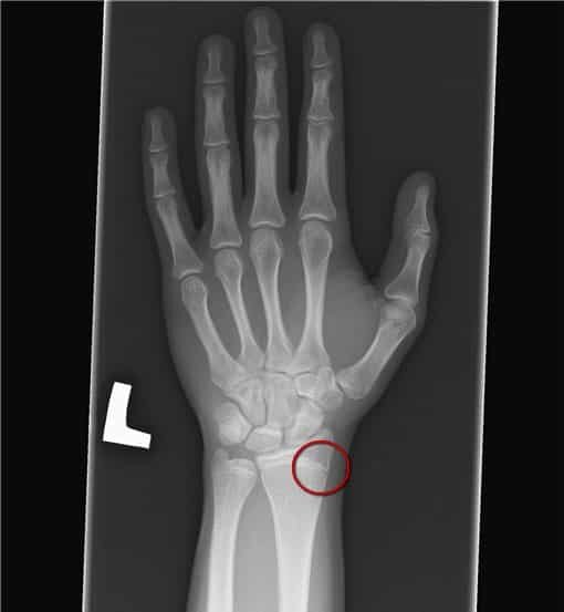 Красным кругом отмечена зона роста костей