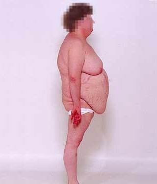 Большая часть лишней массы располагается на животе, при этом конечности становятся все более и более тонкими.