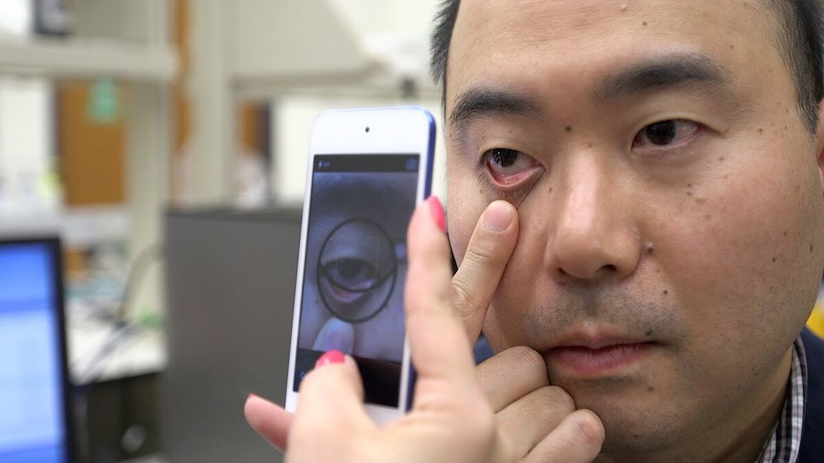 https://www.purdue.edu/newsroom/releases/2020/Q2/smartphone-app-to-help-assess-anemia-by-taking-a-picture-of-a-persons-eyelid.html