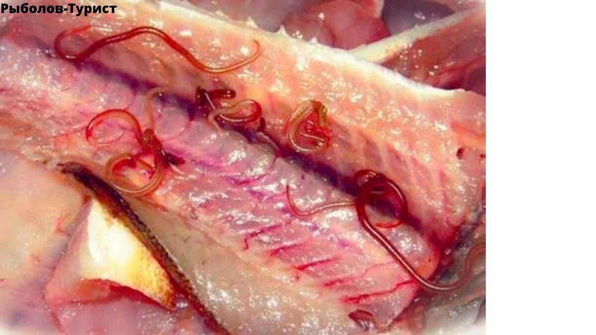 Описторхоз.