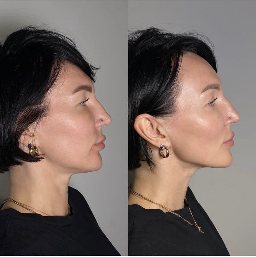 Это  процедура проводится инъекционно, и практически не требует реабилитации.  Благодаря мезокотейлю на основе растительных компонентов,  ваши ткани начинают «дышать», улучшается проводимость сосудов и самое  главное, лимфоток.  В результате уходит отечность, появляется естественный      лифтинг, улучшается качество кожи.  В зеркале уже на следующий день – отдохнувшее свежее лицо, как говорят некоторые очевидцы – как после качественного отдыха. Мы рекомендуем сделать эту процедуру за 3-5  суток до ответственного мероприятия. Процедура представляет собой двухфазный уход: дренажную мезотерапию (она занимает минут 30-40) и микротоковую терапию на следующий день (уже входит в стоимость).