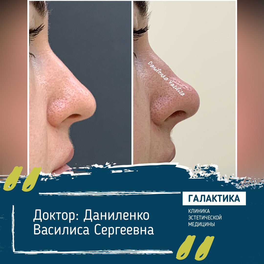 Результат безоперационной ринопластики. Работа выполнена врачом-косметологом, дерматовенерологом Клиники эстетической медицины «Галактика» Даниленко Василисой Сергеевной