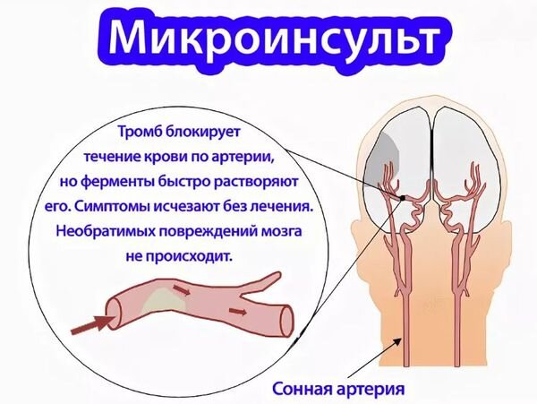 Исход микроприступа