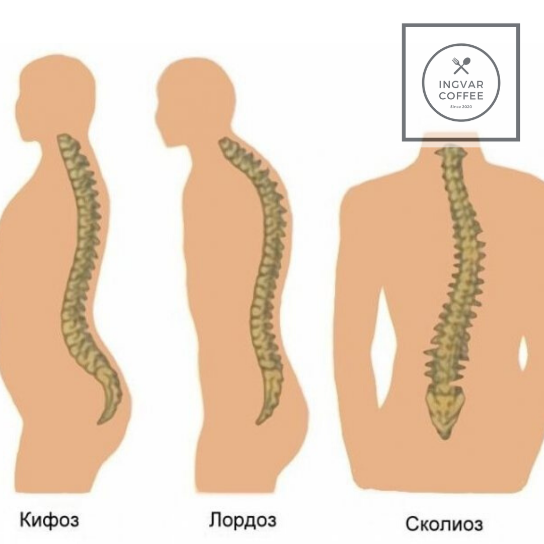 Кифоз человека