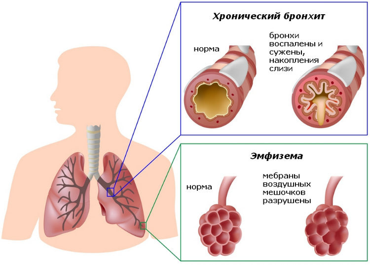 инфографика по ХОБЛ.  Источник medz24.ru