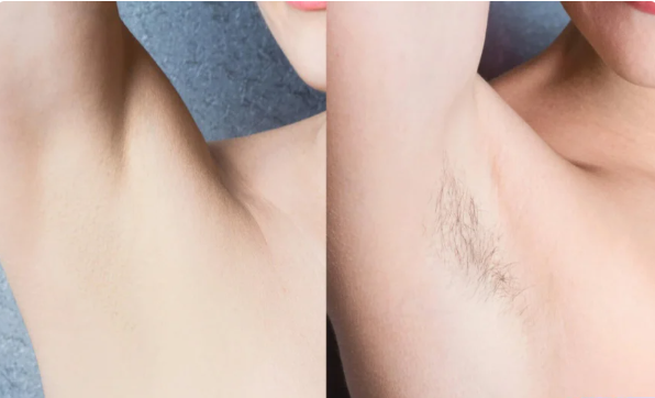 способы убрать волосы. схема удаления волос в глубоком бикини воском. заколоть челку красиво. прически при отращивании челки. прическа на средние волосы зпколото.