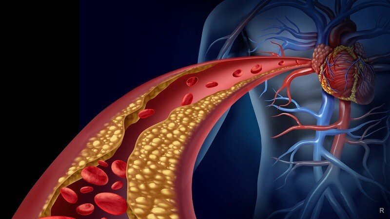 Атеросклероз сужает сосуды и нарушает их эластичность