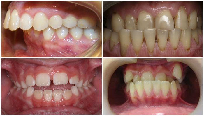 С таким прикусом в армию не возьмут. Источник: JSMILES