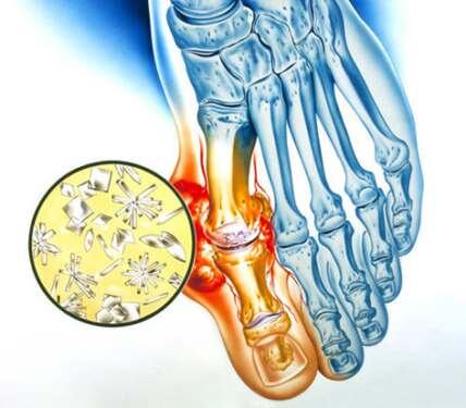 Так выглядит поражение суставов фаланги пальцев ноги.