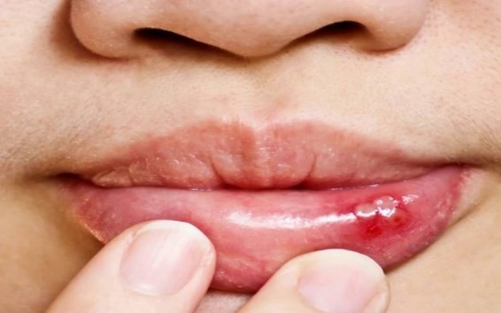 герпес на губе