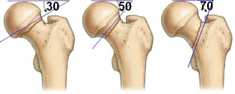  Субкапитальный перелом шейки бедра под разными углами