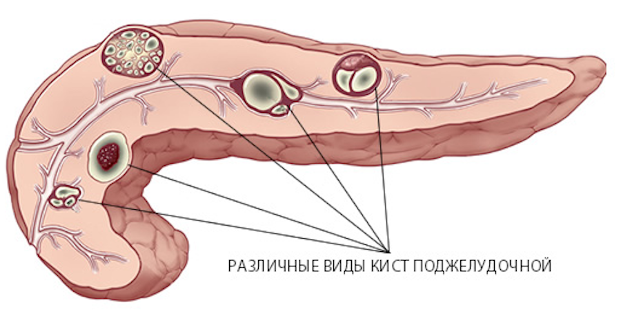 Рак головки члена