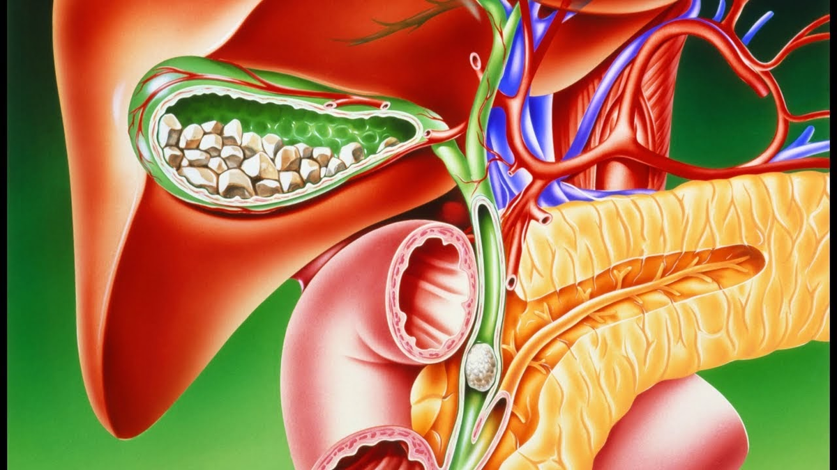 Такие камни вряд ли рассосутся сами