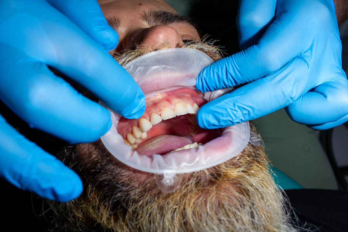 Процесс установки виниров пациенту в нашей клинике