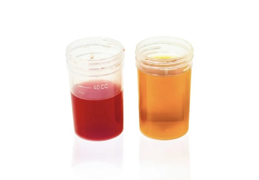 Пример макрогематурии слева