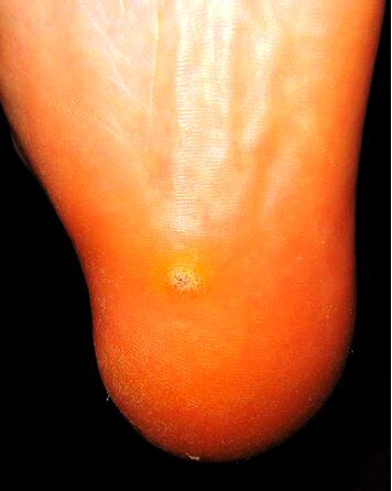 Пяточная шпора