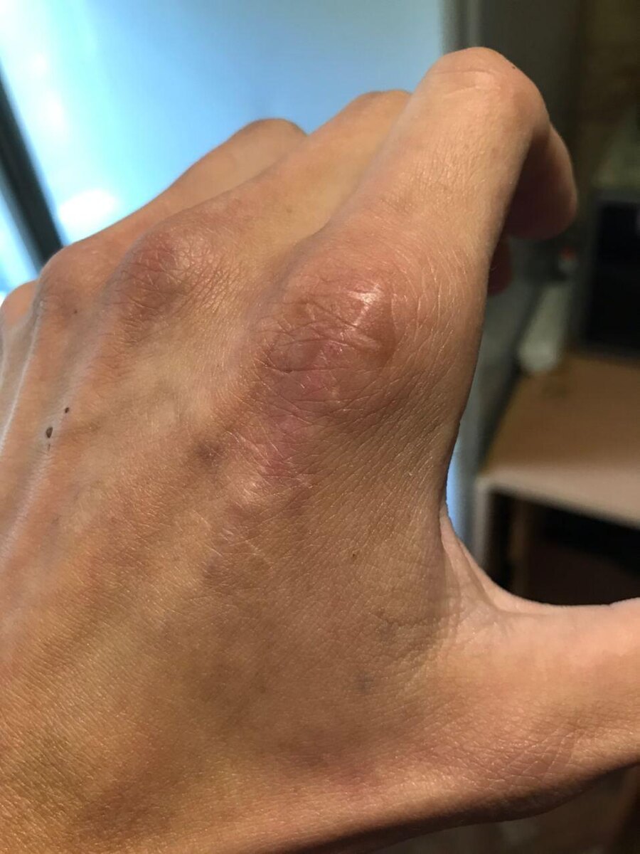 Шраму больше года,но на фото уже результат от недели терапии.Стал чуть ли не в двое меньше,я доволен)