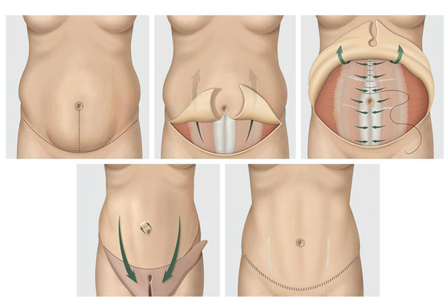 Разрез при пластике живота производится в линии, которую можно скрыть под бельем. В некоторых случаях требуется не только иссечение избытков кожи, но и ушивание брюшной мышцы. Фото с сайта хирурга Д.Р.Гришкяна, имеются противопоказания, требуется консультация специалиста .